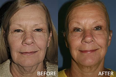 st louis facial cosmetic surgery.